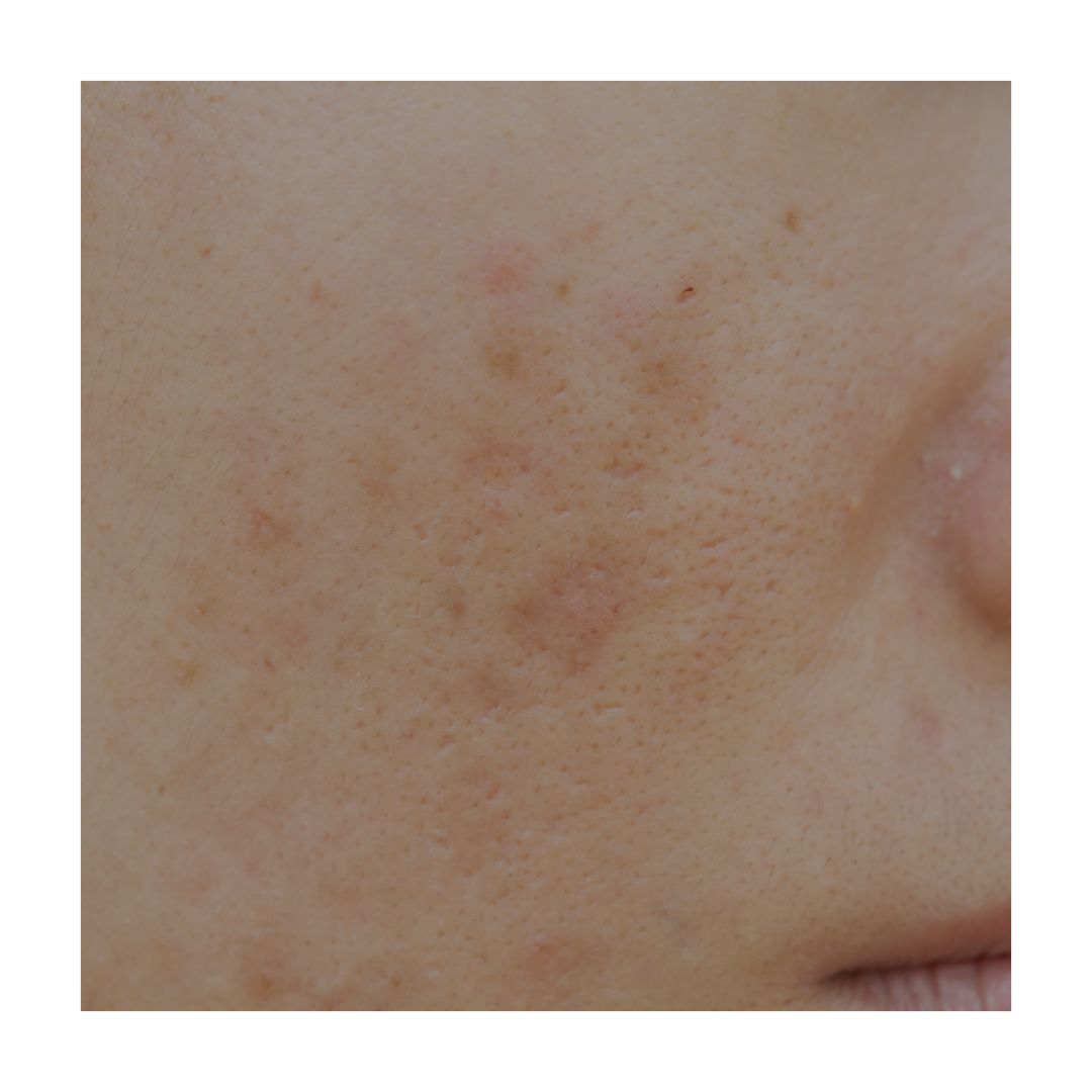 Dark Spots & Pigmentation
